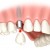Necesitatea unui implant dentar – avantaje și dezavantaje